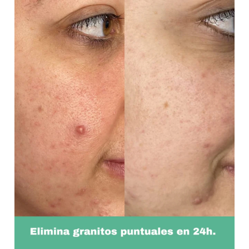 CR Cosmetics - *Purifying* - Anti-Pickel-Roll-on