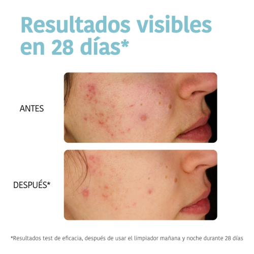 Iroha Nature - *Acne Prone Skin* - Reinigendes Reinigungsmittel - Zu Akne neigende Haut