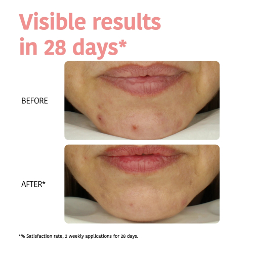 Iroha Nature - Maske Perfect Skin Peeling - Glykolsäure