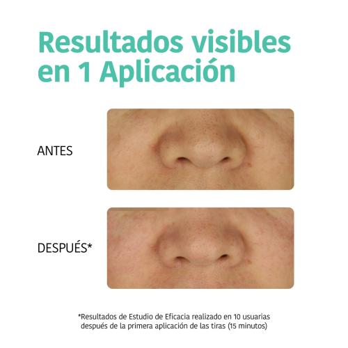 Iroha Nature - Detox Streifen Anti Black Dots - Kohlenstoff