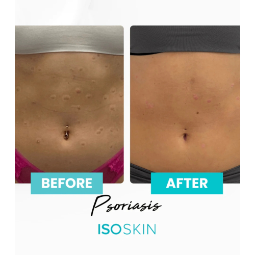 ISOCLEAN - *ISOSKIN* - Gesichts- und Körperspray Hypochlorous - 100 ml