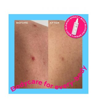 Revolution Skincare - *Body Skincare* – Körperspray gegen Hautunreinheiten