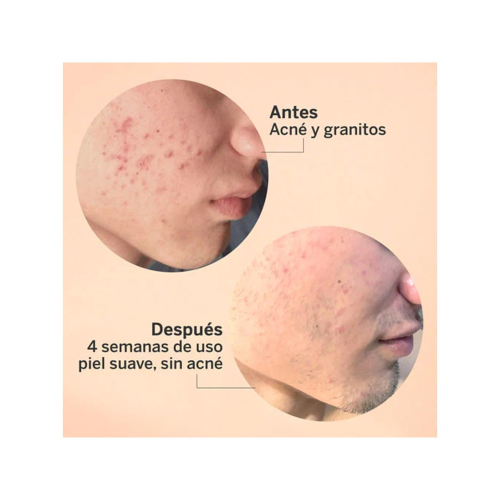 SEGLE – AHA/BHA-Peeling-Gesichtsserum