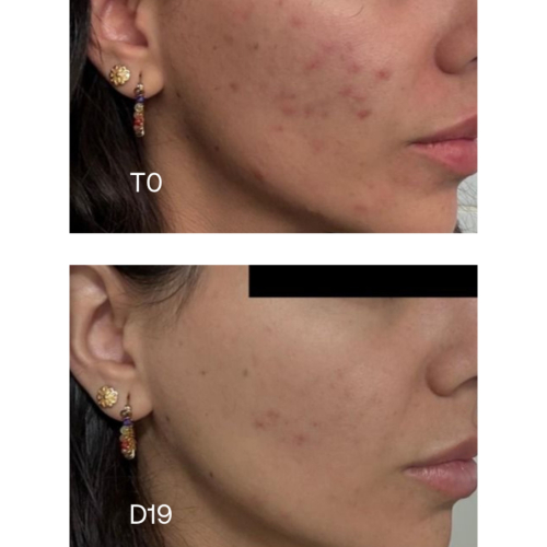 Sensilis - *Oily Skin* - Konzentrat gegen Hautunreinheiten Pure 15AZ